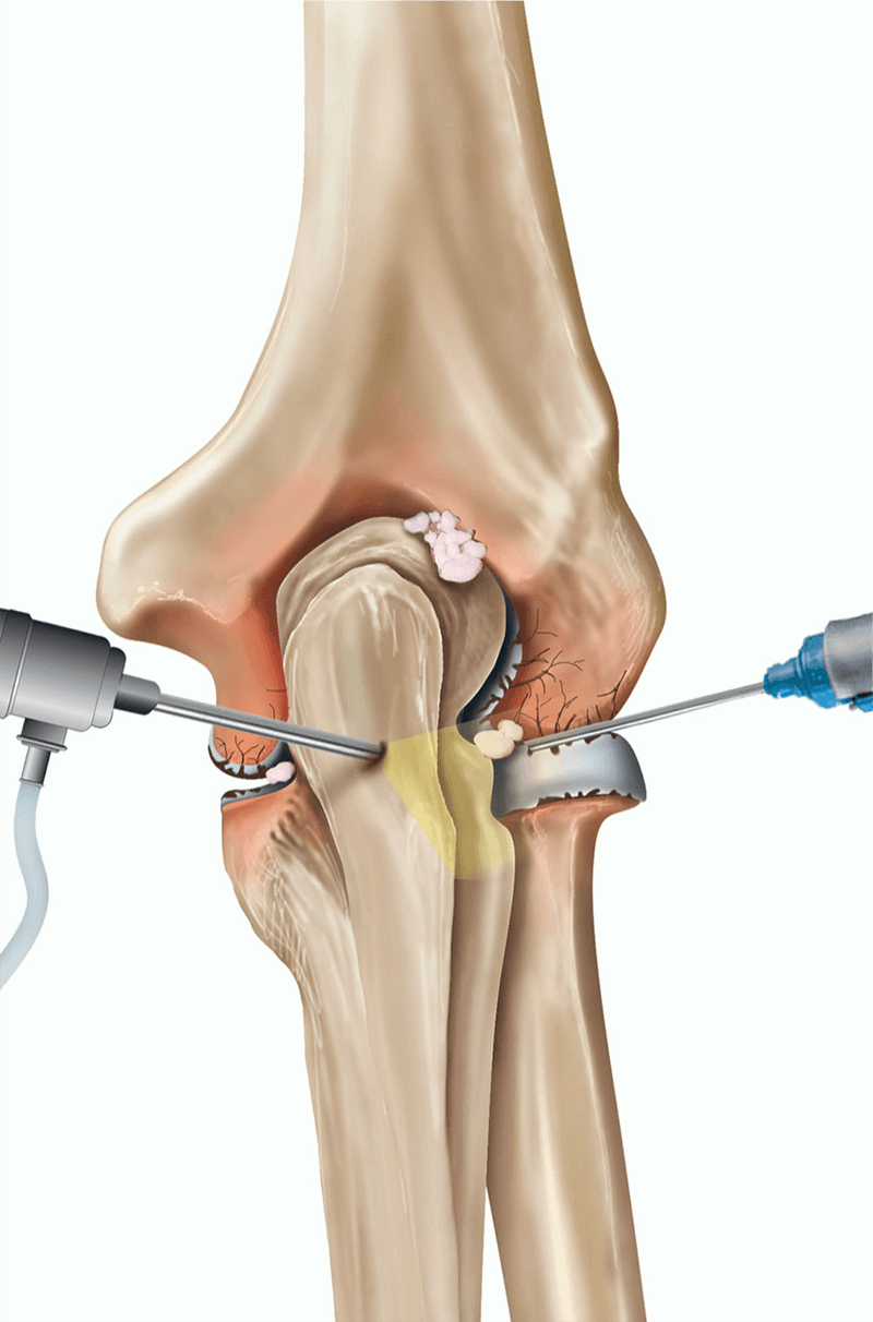 Elbow arthroscopy